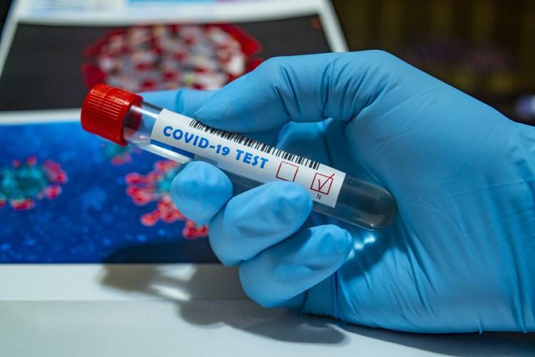 U Srpskoj od danas jeftiniji komercijalni testovi na virus korona U Srpskoj od danas jeftiniji komercijalni testovi na virus korona