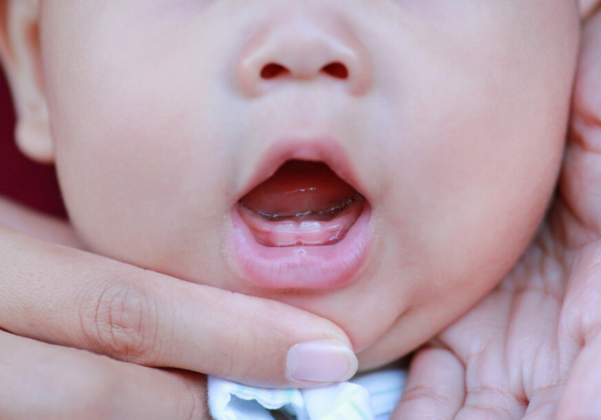 „Neki kažu da je ovo medicinsko čudo“ U Banjaluci rođena beba sa jednim zubom
