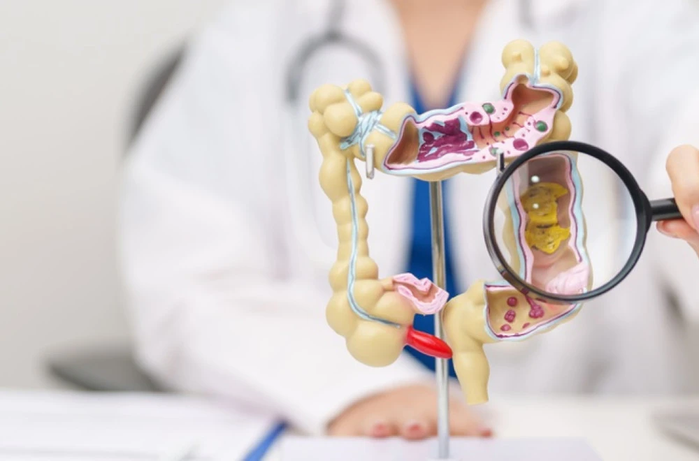 Porast oboljenja od raka debelog crijeva – zašto stručnjaci upozoravaju?